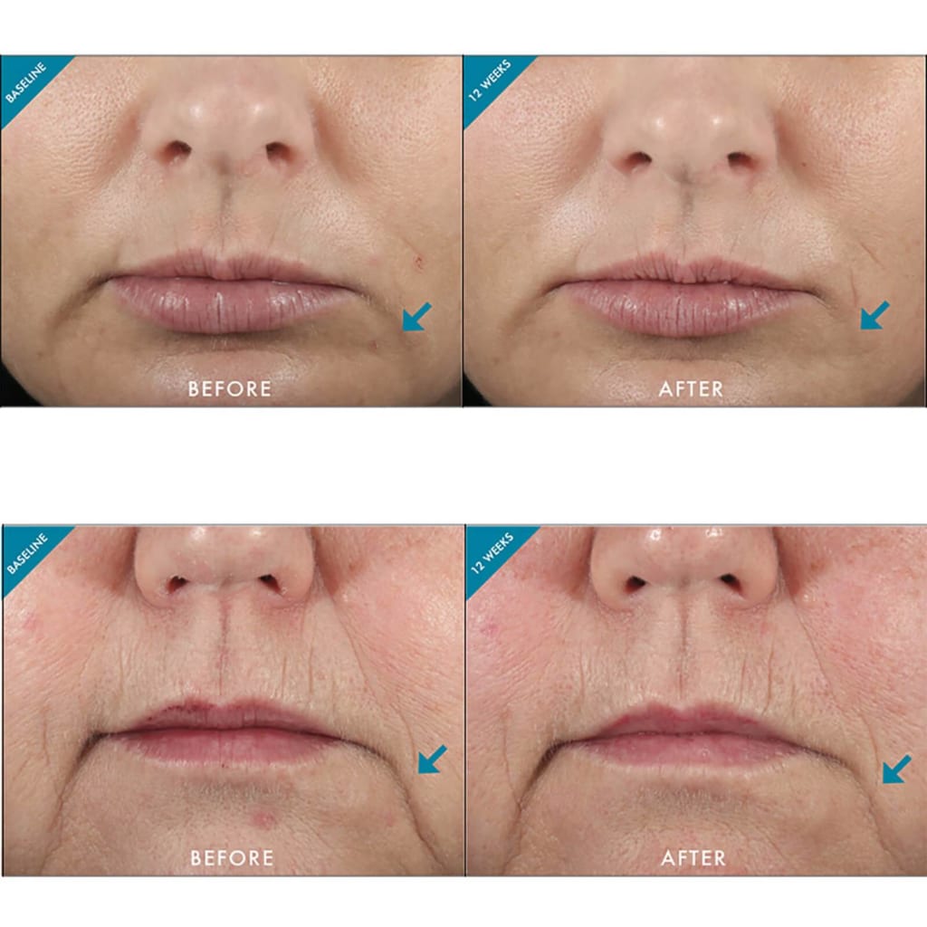 PHARMAFORM HYDRA 5 COMPLETE SERUM: Tinh Chất Dưỡng Ẩm Chuyên Sâu, Phục Hồi & Tái Tạo Làn Da Khỏe Mạnh