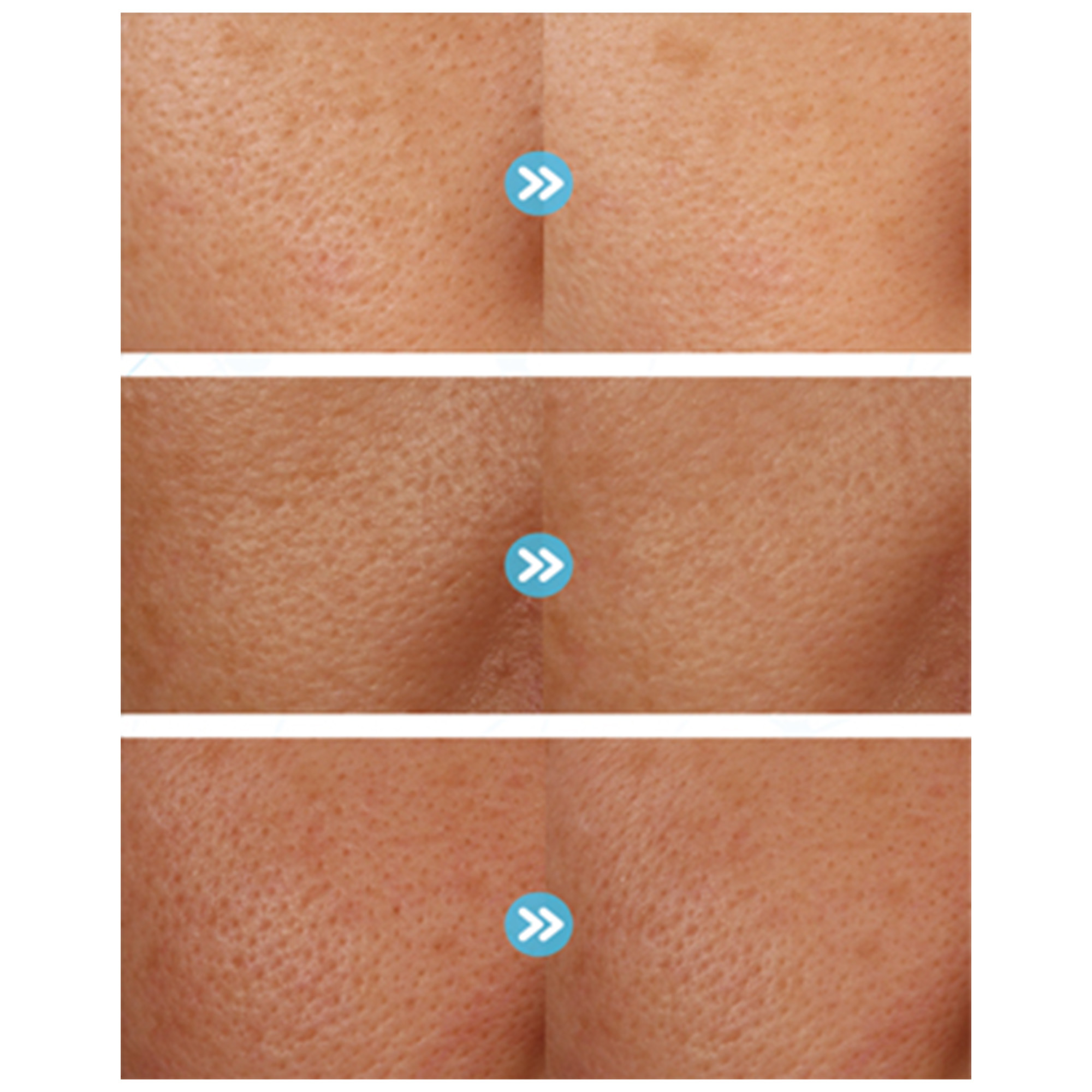 LIỆU PHÁP CO2 CARBOXY: Thanh Lọc Da Chuyên Sâu, Trẻ Hóa Không Xâm Lấn