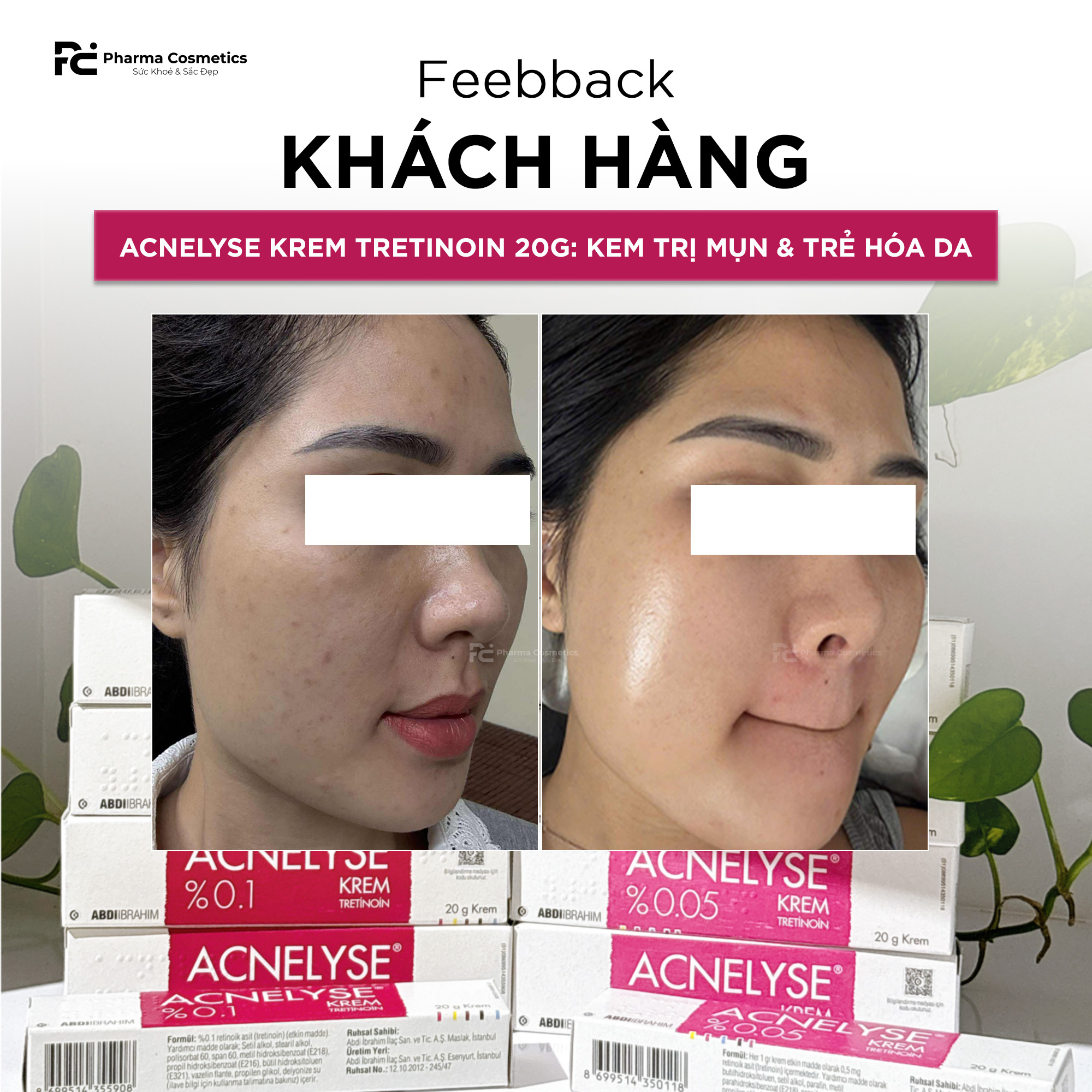 ACNELYSE KREM TRETINOIN 20G: Kem Trị Mụn & Trẻ Hóa Da