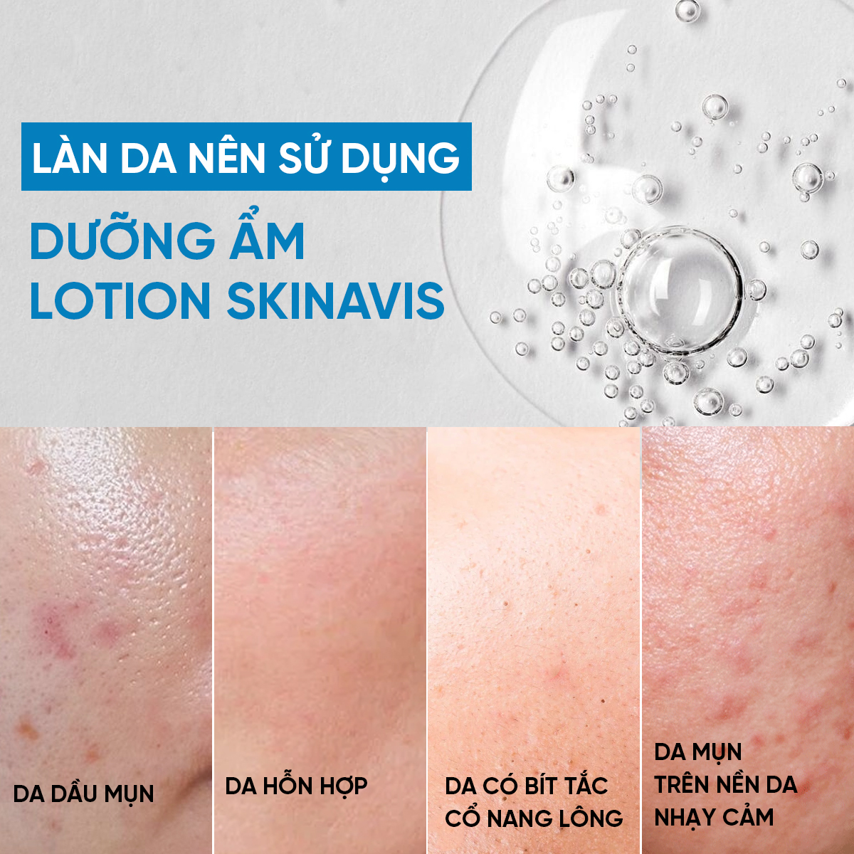 Skinavis Moisturizer Lotion: Dưỡng Ẩm Chuyên Biệt Cho Da Dầu Mụn & Cơ Địa Bít Tắc