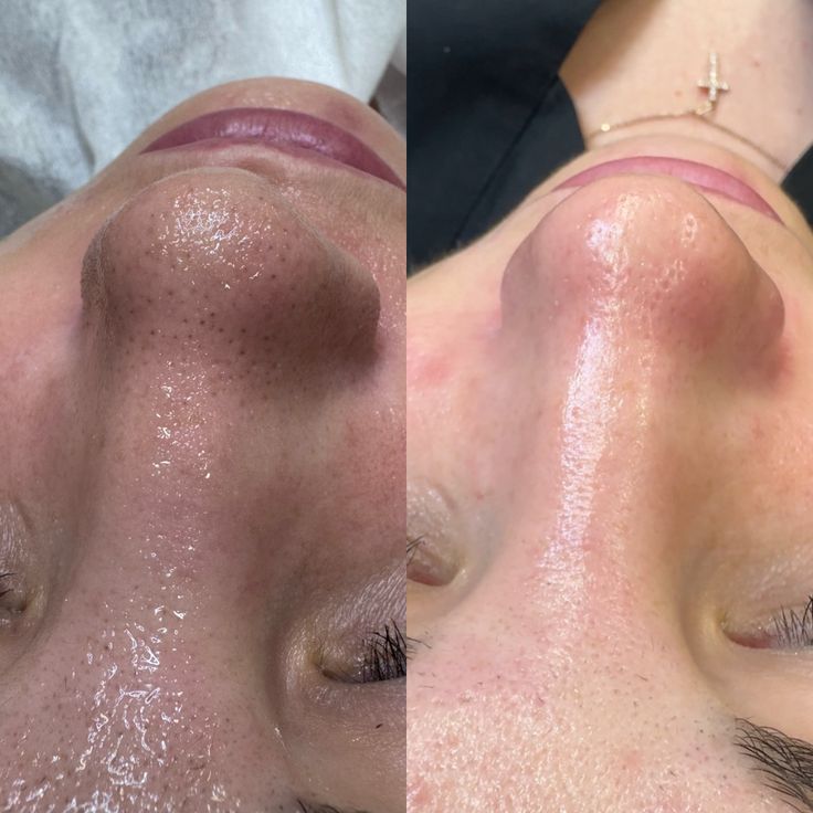 TRỊ LIỆU CHUYÊN SÂU GLOW-UP: Giải Pháp Toàn Diện Cho Làn Da Đô Thị