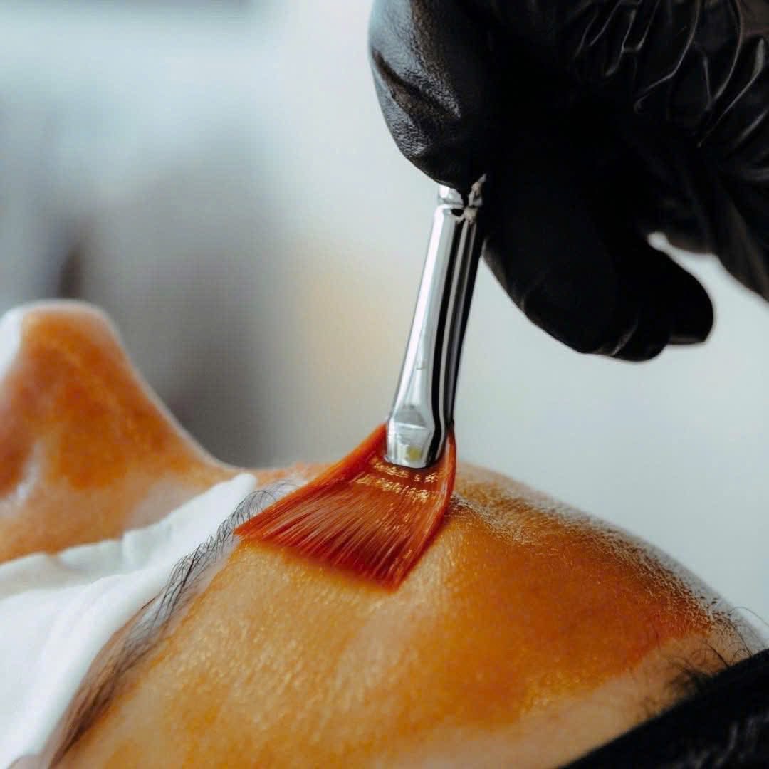 MESOPEEL® MD MELANOSTOP TRANEX: Giải Pháp Peel Đặc Trị Nám & Tăng Sắc Tố Chuyên Sâu