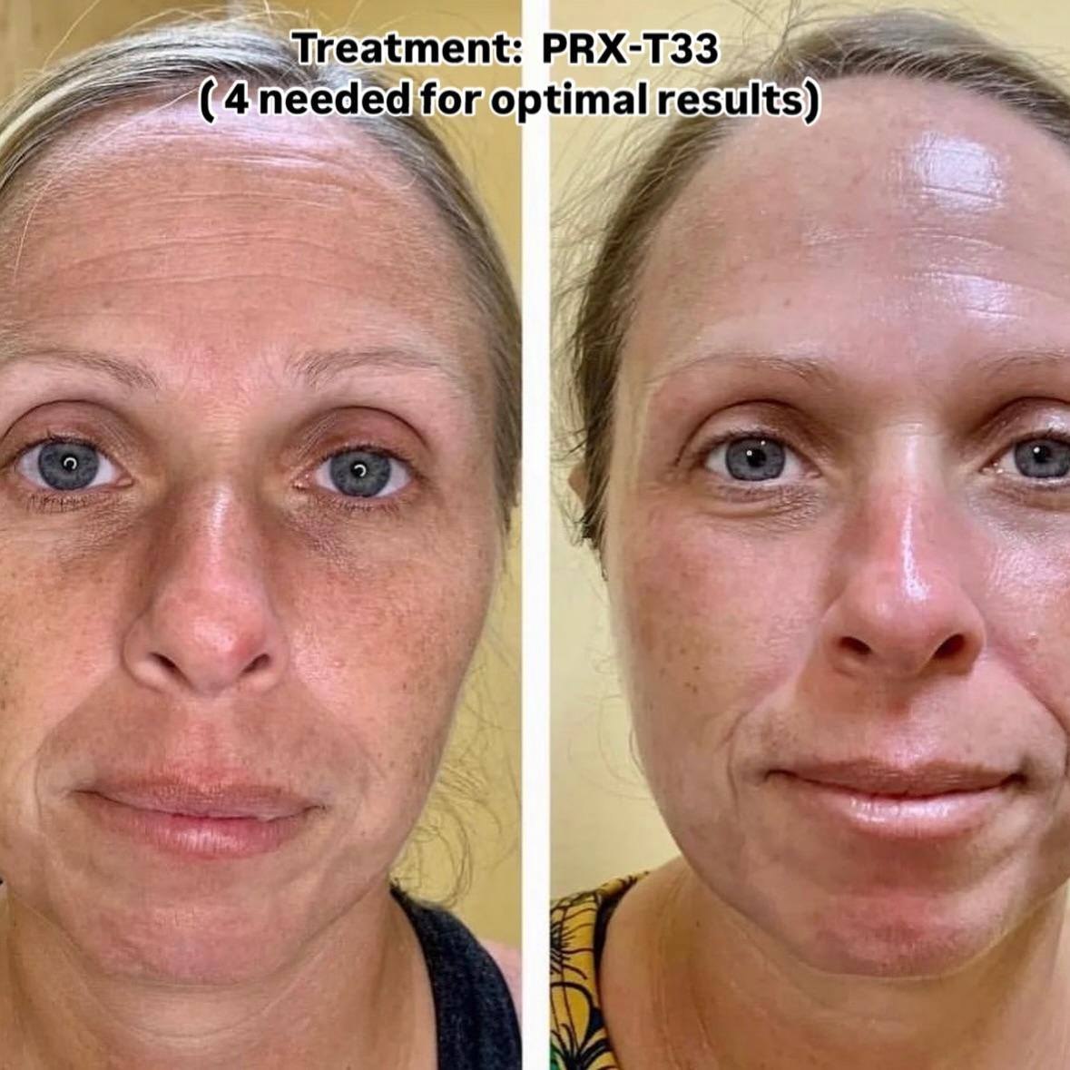 WIQO PRX-T33: Biorevitalization Thế Hệ Mới - Trẻ Hóa Da, Săn Chắc & Sáng Rạng Ngay Lập Tức