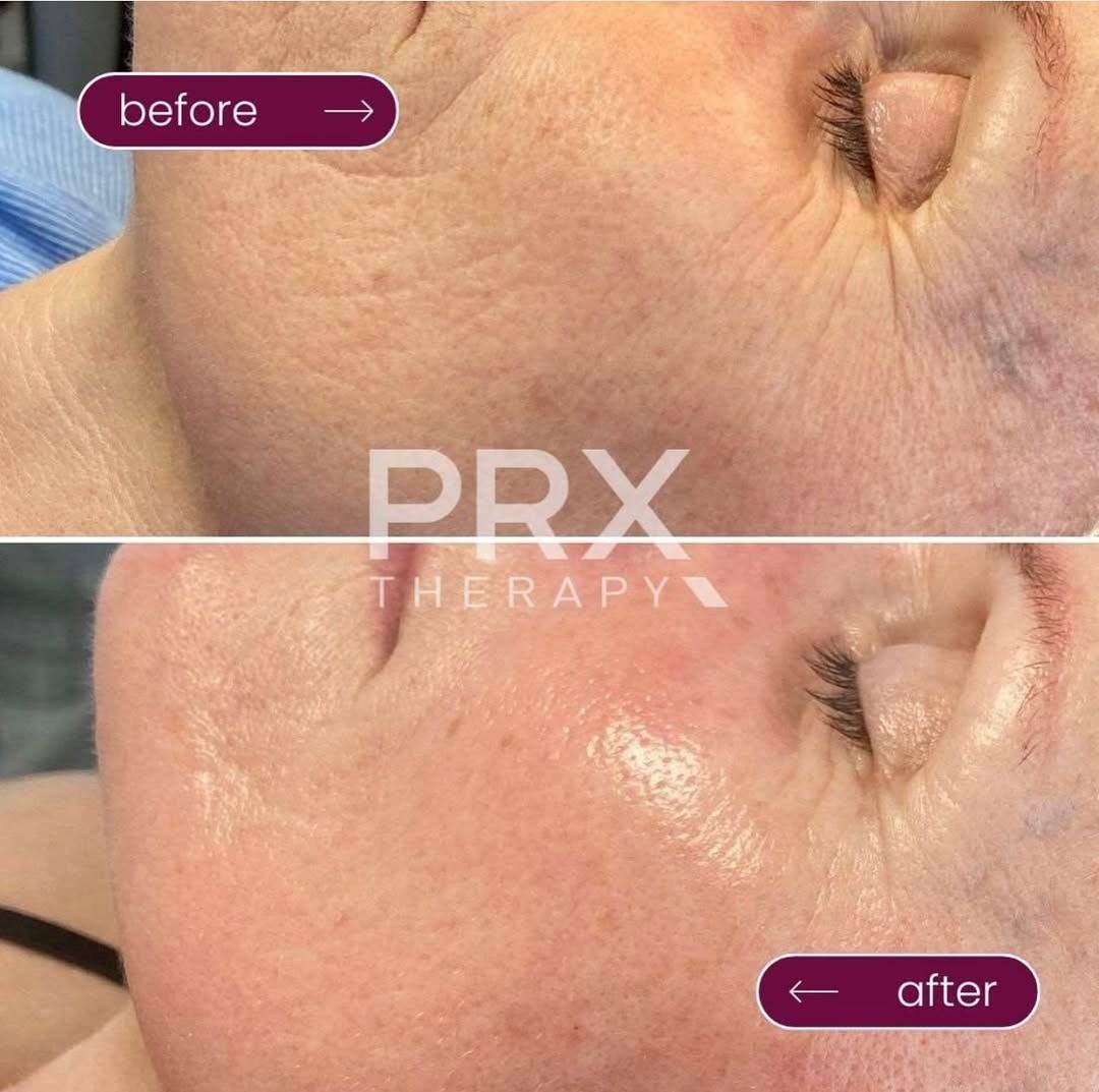 WIQO PRX-T33: Biorevitalization Thế Hệ Mới - Trẻ Hóa Da, Săn Chắc & Sáng Rạng Ngay Lập Tức