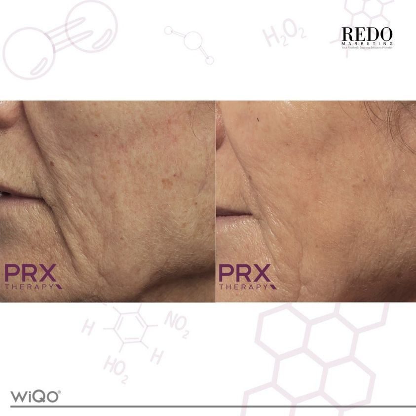 WIQO PRX-T33: Biorevitalization Thế Hệ Mới - Trẻ Hóa Da, Săn Chắc & Sáng Rạng Ngay Lập Tức