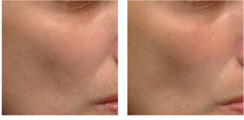 PHARMAFORM AZE – LIFT SERUM: Tinh Chất Kiềm Dầu & Giảm Mụn, Cho Làn Da Mịn Màng Săn Chắc