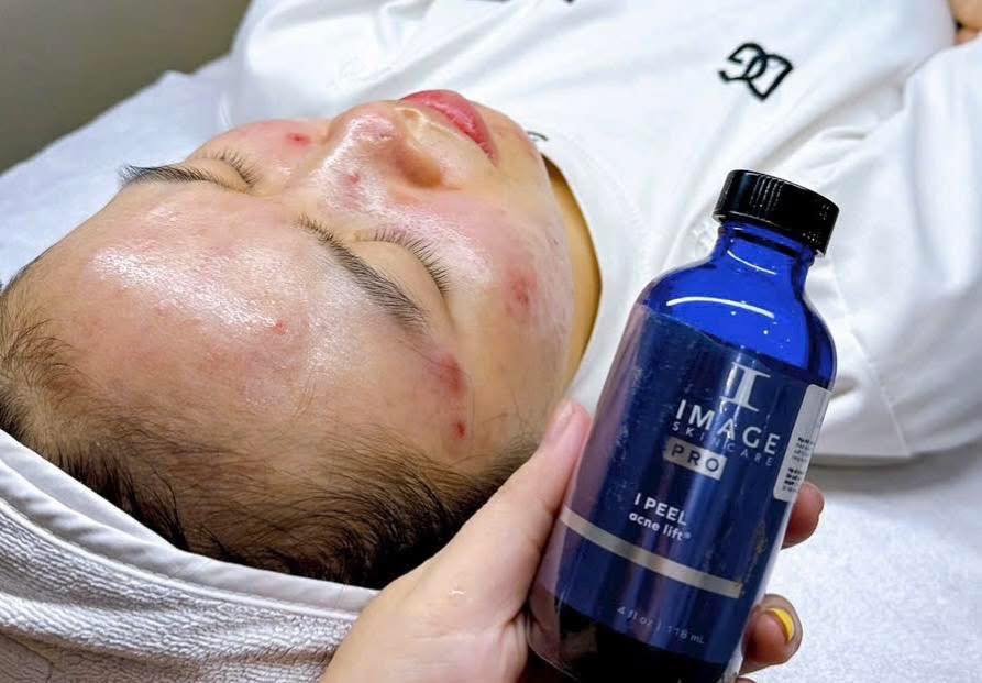ACNE LIFT® THANH LỌC DA: Chấm Dứt Tình Trạng Bít Tắc và Mụn Ẩn