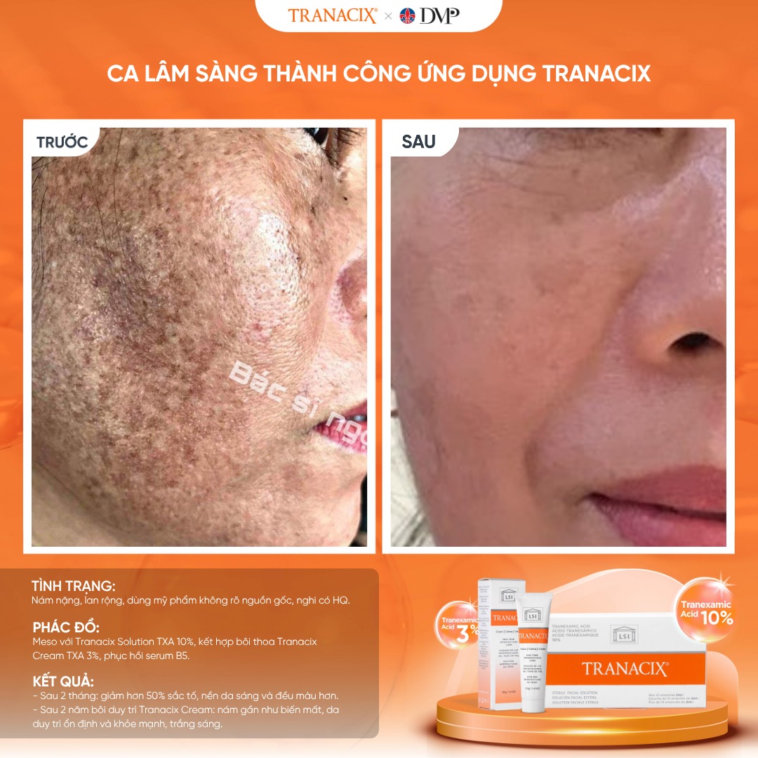 Tranacix Cream 3% – Giải Pháp Đột Phá Điều Trị Nám, Hồng Ban & Tăng Sắc Tố