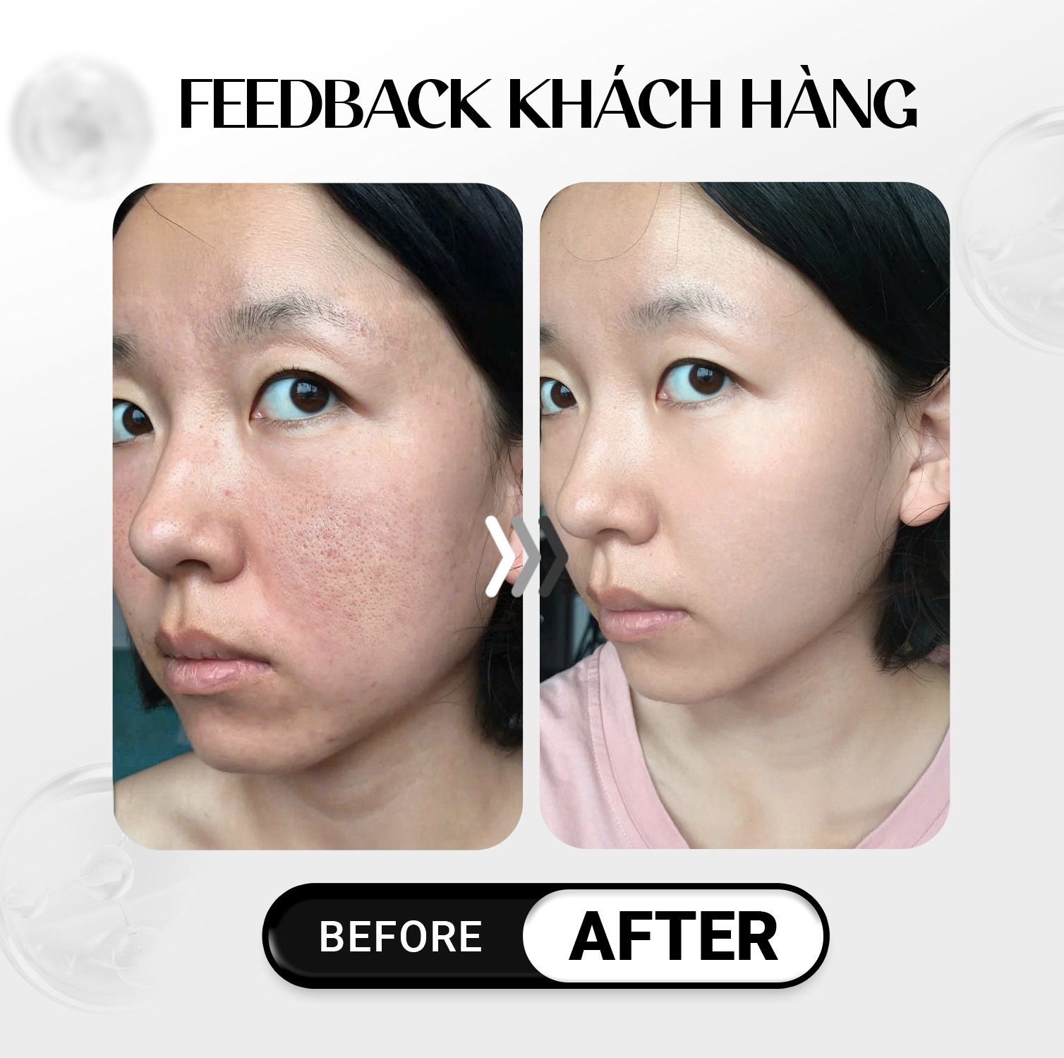 LINERASE COLLAGEN: ĐỈNH CAO TRẺ HÓA SINH HỌC CHUẨN Y KHOA TỪ CHÂU ÂU