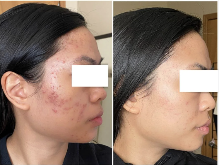 Obagi Tretinoin 0.1% Cream – Kem Dưỡng Chuyên Sâu Tối Ưu Bề Mặt & Hỗ Trợ Giảm Mụn Cấp Độ Cao