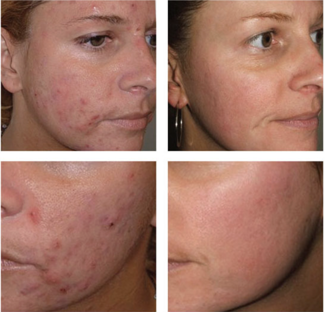Obagi Tretinoin 0.1% Cream – Kem Dưỡng Chuyên Sâu Tối Ưu Bề Mặt & Hỗ Trợ Giảm Mụn Cấp Độ Cao