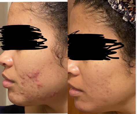 Obagi Tretinoin 0.1% Cream – Kem Dưỡng Chuyên Sâu Tối Ưu Bề Mặt & Hỗ Trợ Giảm Mụn Cấp Độ Cao