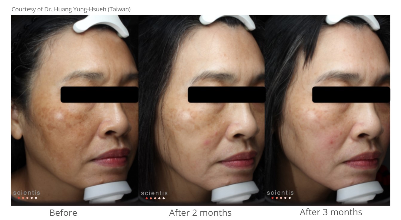 PHARMAFORM CYSTANE MELA CREAM: Kem Giảm Nám, Chống Oxy Hóa Với Công Thức Tiên Tiến