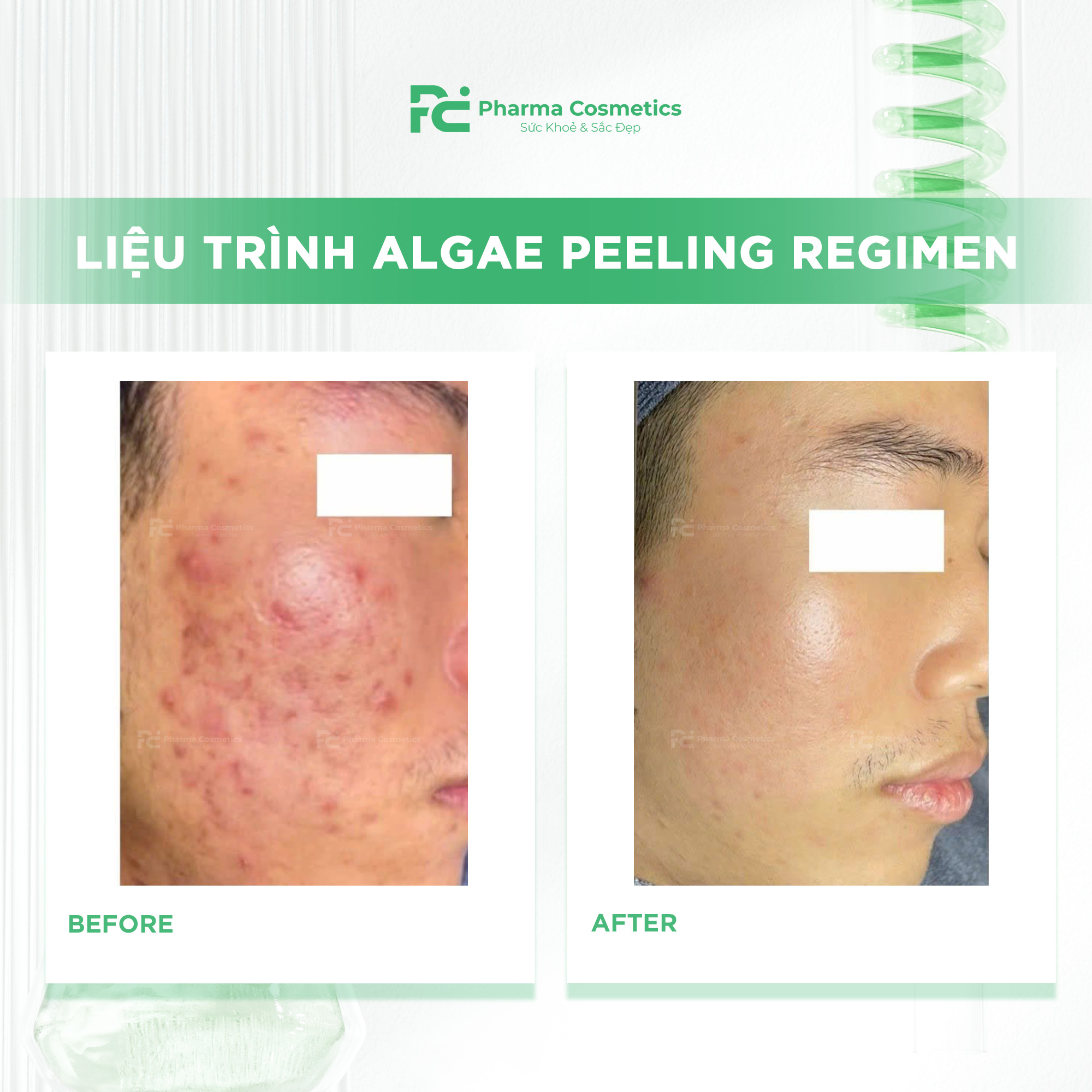 DECAAR ALGAE PEELING REGIMEN: Vi Tảo Sinh Trị Liệu Gen