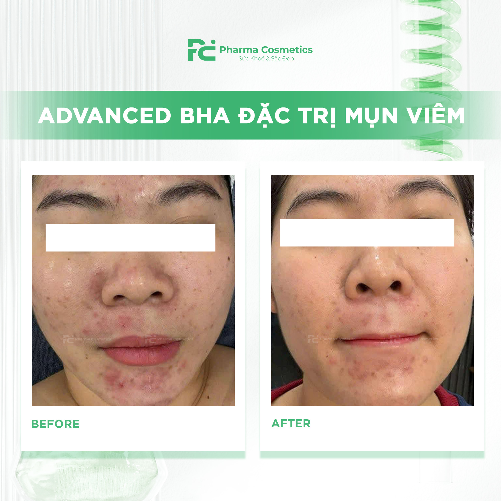 ADVANCED BHA ĐẶC TRỊ MỤN VIÊM: Giải Pháp Chuyên Sâu Cho Da Dầu & Mụn Cấp Độ Nặng