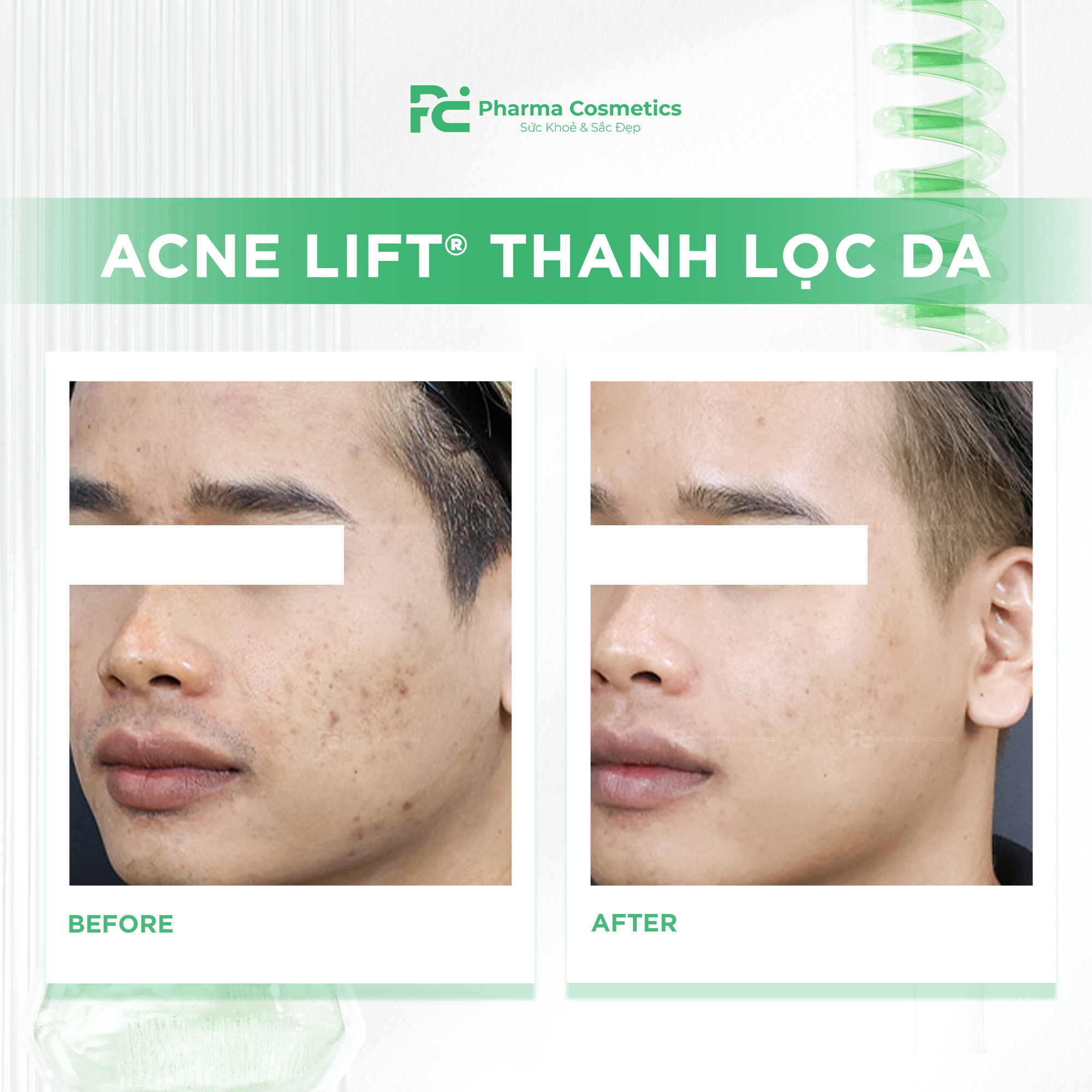 ACNE LIFT® THANH LỌC DA: Chấm Dứt Tình Trạng Bít Tắc và Mụn Ẩn