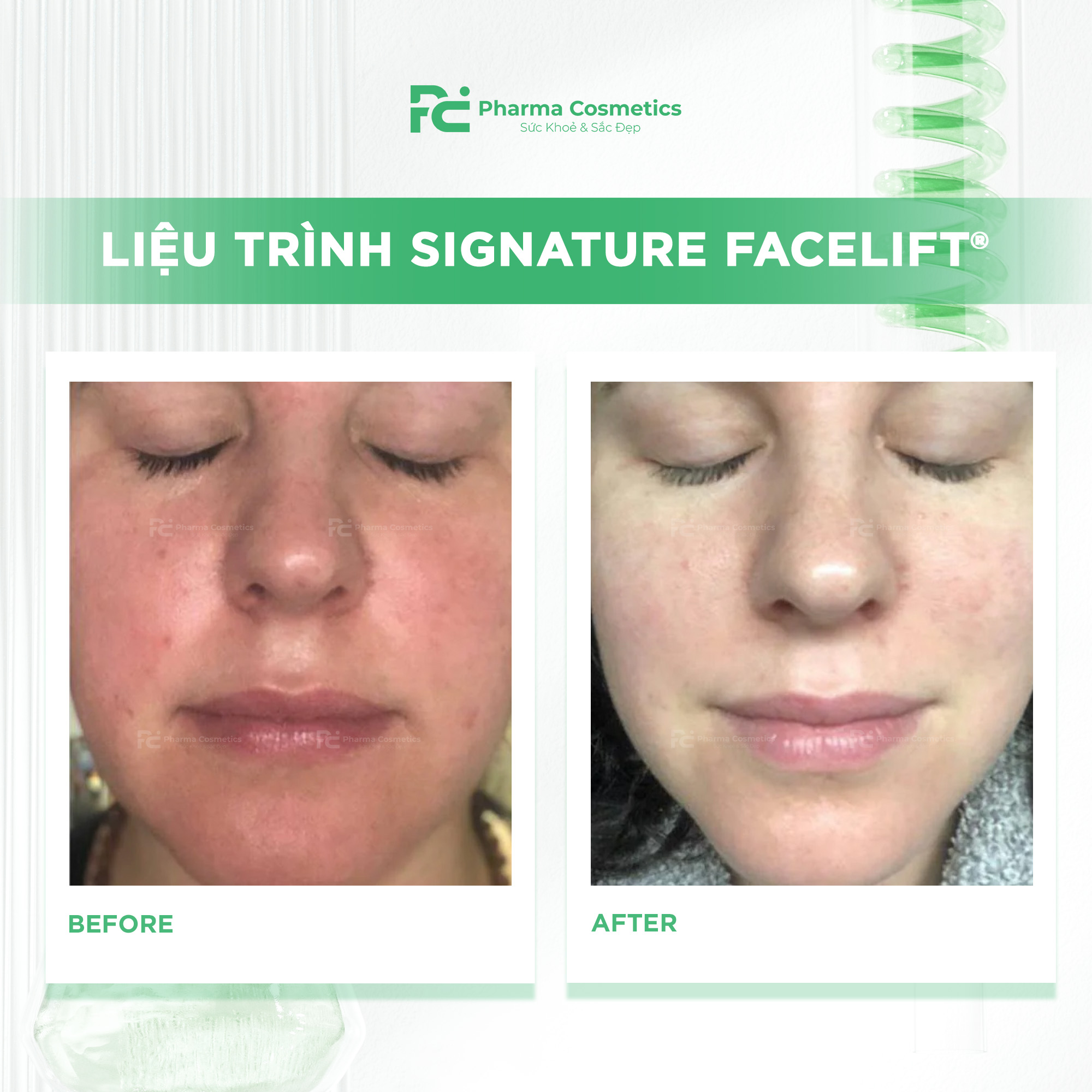 SIGNATURE FACELIFT®: Phục Hồi Làn Da Nhạy Cảm, Giãn Mao Mạch Tối Ưu