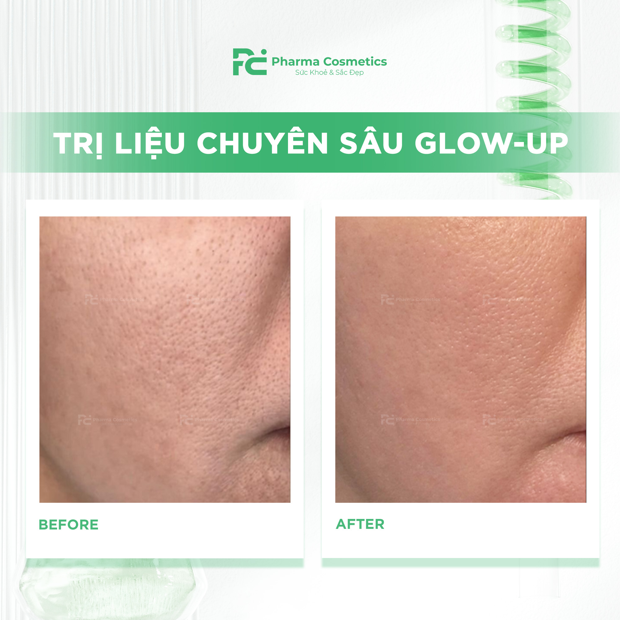 TRỊ LIỆU CHUYÊN SÂU GLOW-UP: Giải Pháp Toàn Diện Cho Làn Da Đô Thị