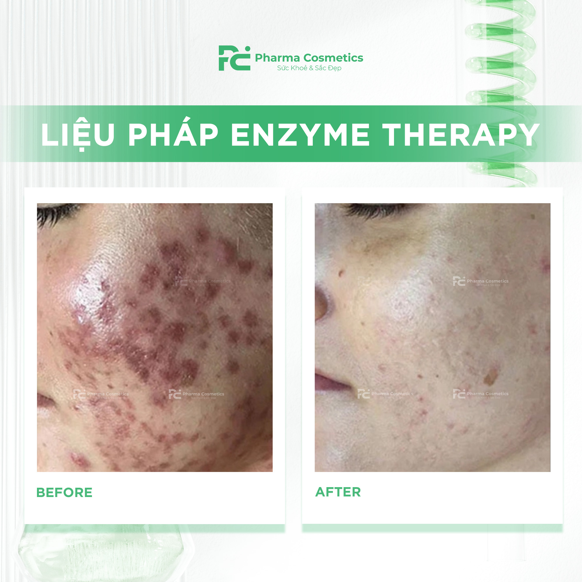 LIỆU PHÁP ENZYME THERAPY: Phục Hồi Làn Da "Không Dung Nạp Điều Trị