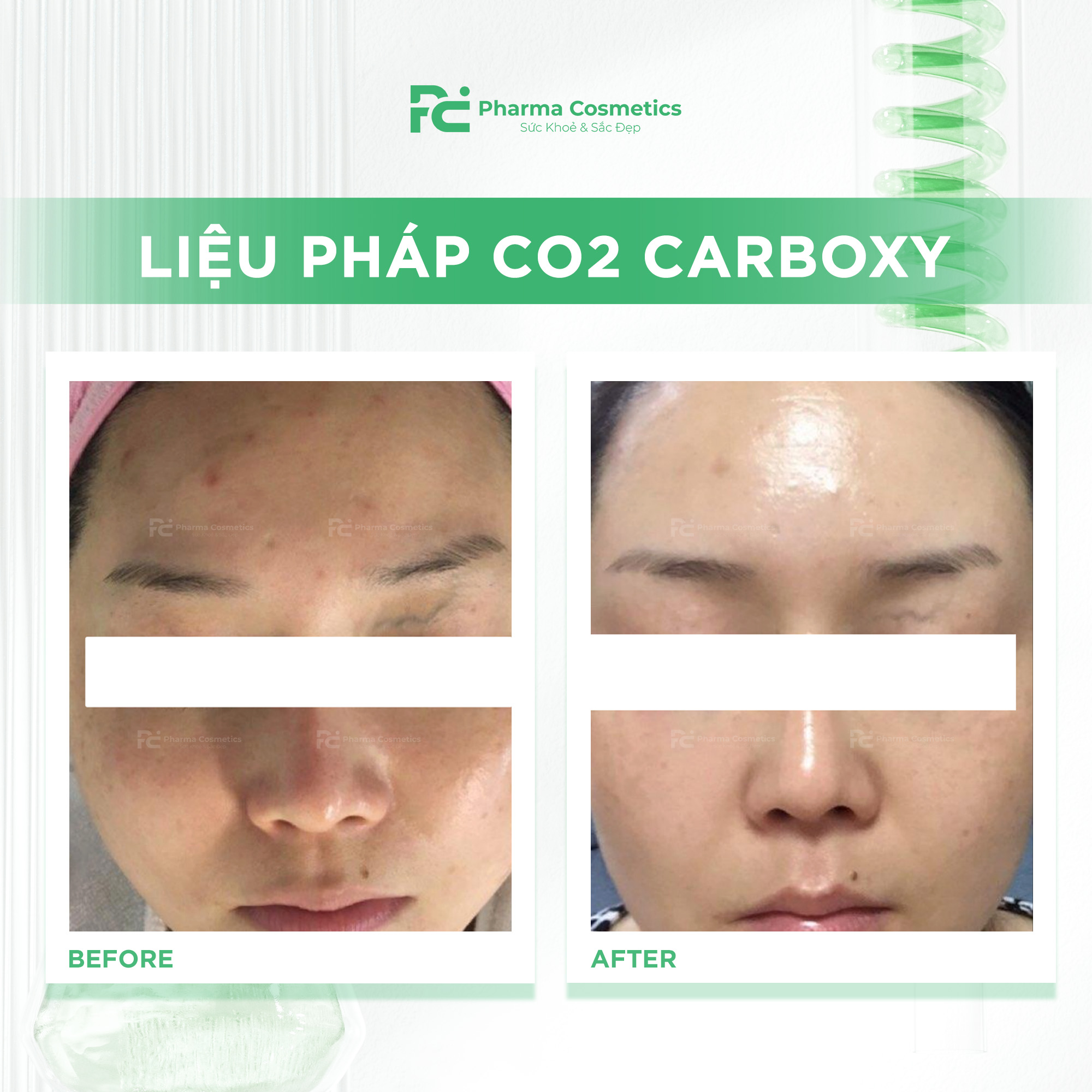 LIỆU PHÁP CO2 CARBOXY: Thanh Lọc Da Chuyên Sâu, Trẻ Hóa Không Xâm Lấn