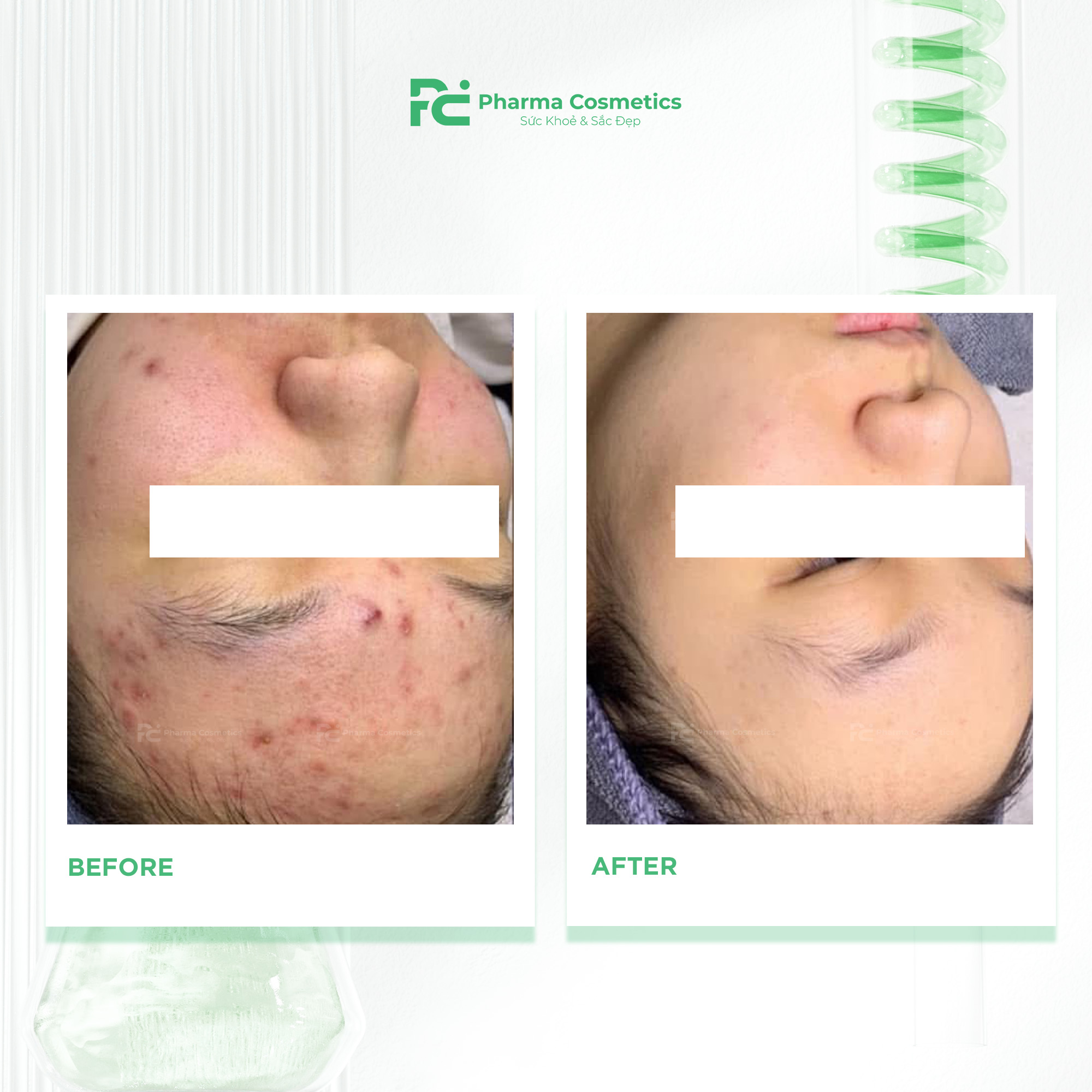 DECAAR ALGAE PEELING REGIMEN: Vi Tảo Sinh Trị Liệu Gen