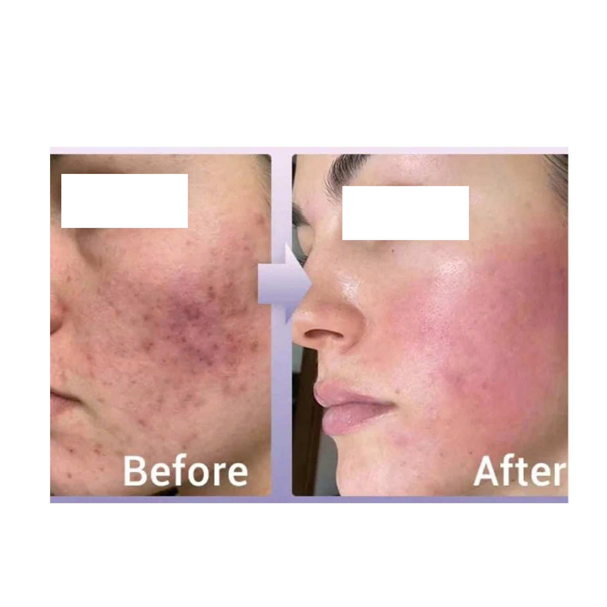 LIỆU PHÁP GROWTH FACTOR MICRONEEDLING: Giải Pháp Toàn Diện Cho Làn Da Sẹo Mụn, Lão Hóa, Thâm Nám