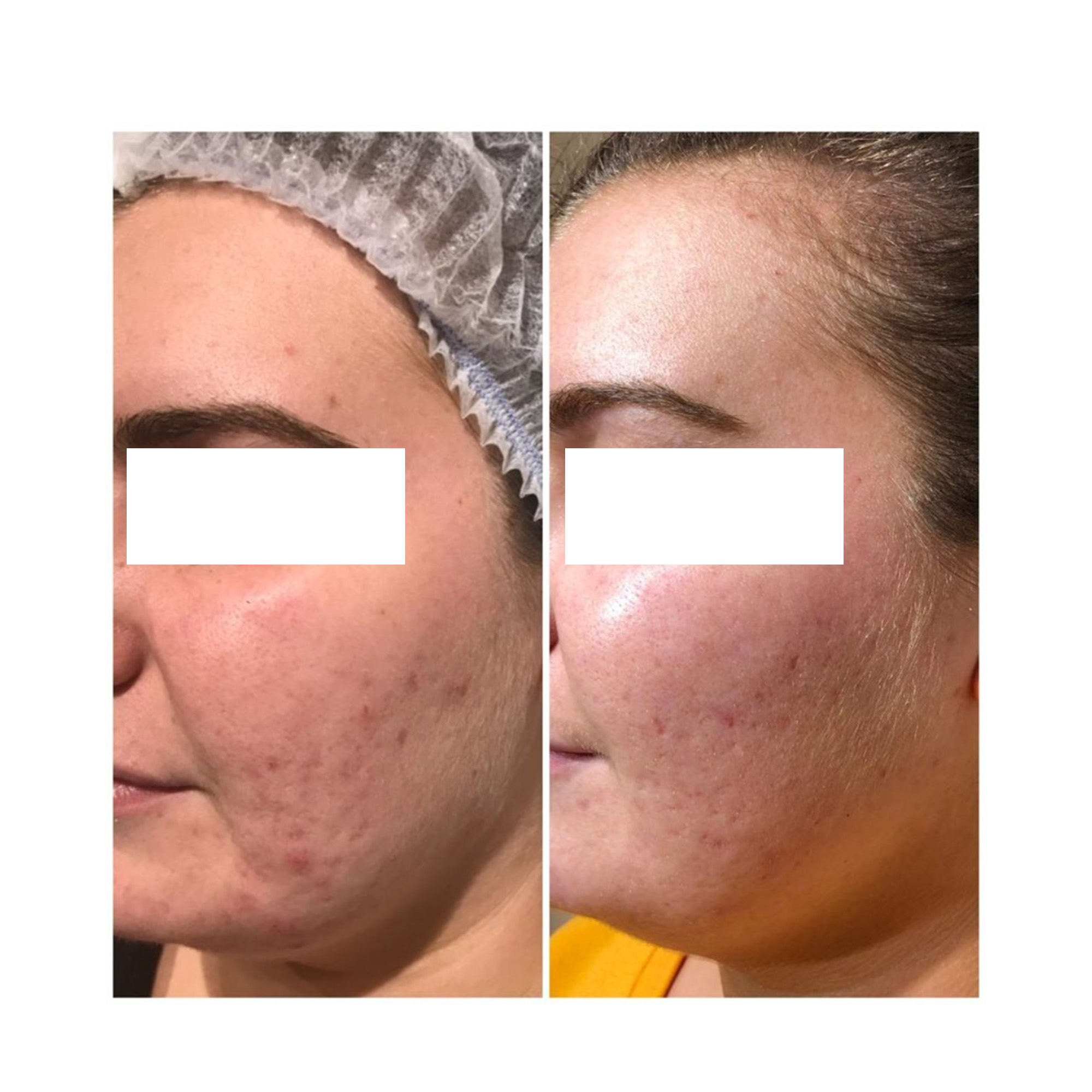 LIỆU PHÁP GROWTH FACTOR MICRONEEDLING: Giải Pháp Toàn Diện Cho Làn Da Sẹo Mụn, Lão Hóa, Thâm Nám