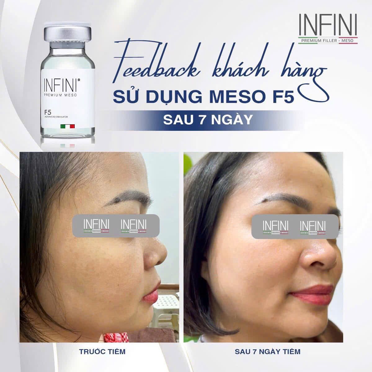 INFINI PREMIUM MESO F5: Giải Pháp Meso Trẻ Hóa Tế Bào Toàn Diện