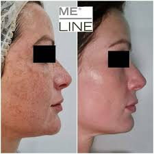 MELINE 02 CAUCASIAN SKIN NIGHT / KEM ĐẶC TRỊ NÁM, PHÂN GIẢI SẮC TỐ