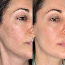 PHARMAFORM B9-12 PLACENTA SERUM: Tinh Chất Chuyên Biệt - Phục Hồi & Tái Tạo Làn Da Tổn Thương