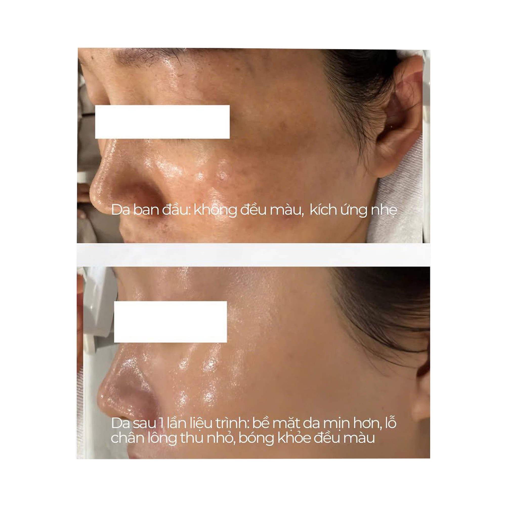 RESURFACE²: Liệu Trình Peel Tái Tạo Tế Bào & Trẻ Hóa Chuyên Sâu Từ Ý