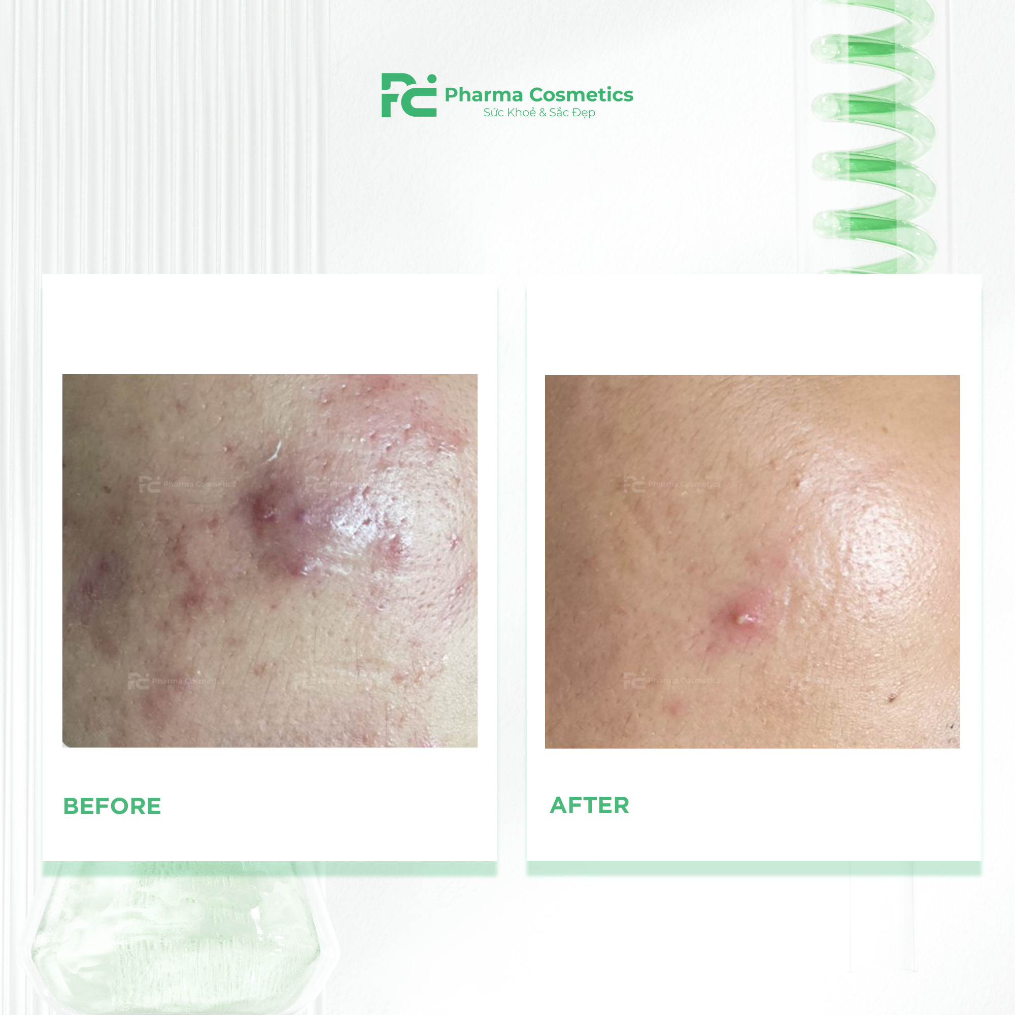 DECAAR ALGAE PEELING REGIMEN: Vi Tảo Sinh Trị Liệu Gen