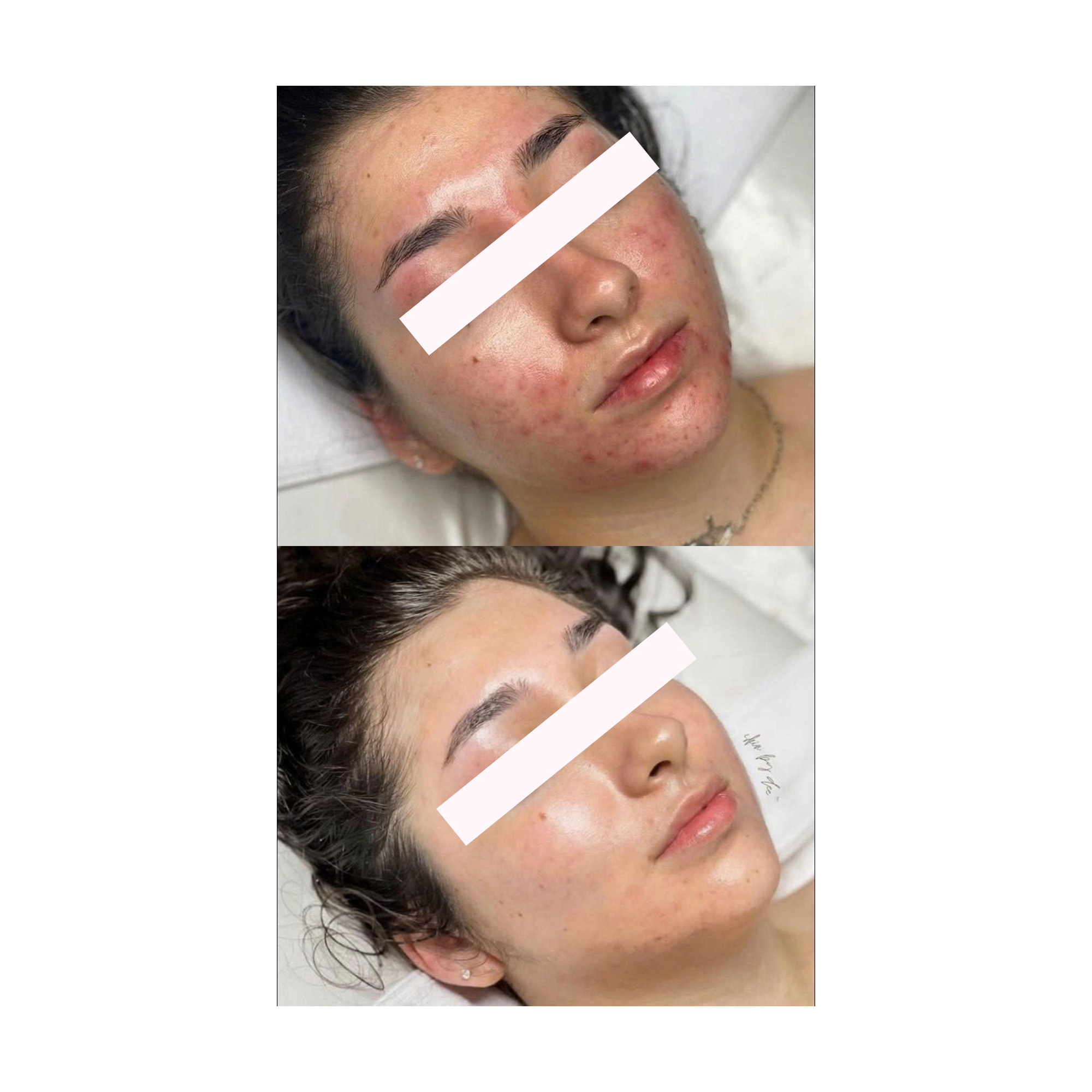 SIGNATURE FACELIFT®: Phục Hồi Làn Da Nhạy Cảm, Giãn Mao Mạch Tối Ưu