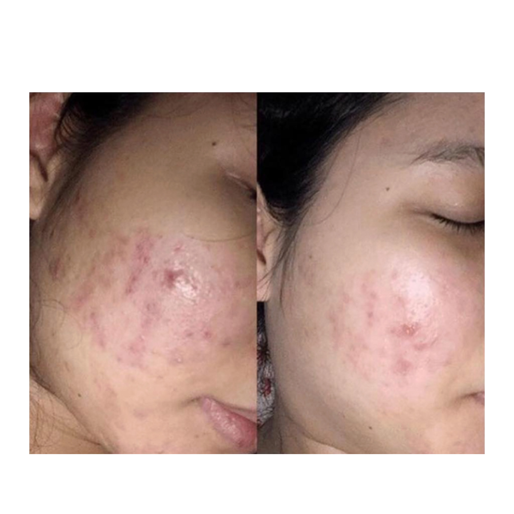 LIỆU PHÁP CO2 CARBOXY: Thanh Lọc Da Chuyên Sâu, Trẻ Hóa Không Xâm Lấn