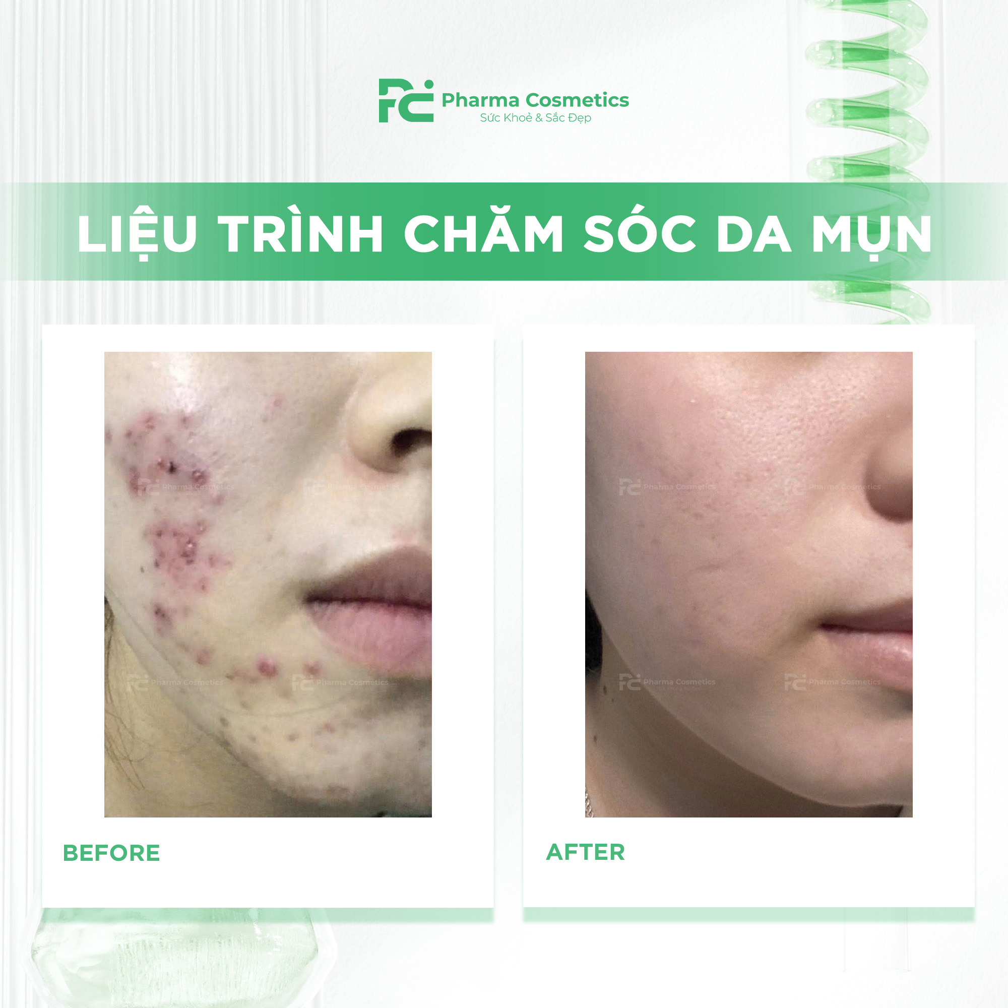 HISTOLAB LIỆU TRÌNH CHĂM SÓC DA MỤN CHUYÊN SÂU: Giải Pháp Thanh Lọc và Tái Tạo Làn Da Khỏe Mạnh