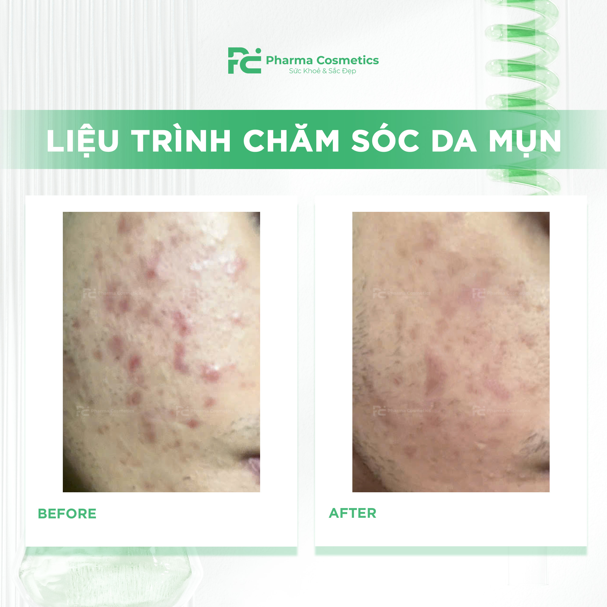 HISTOLAB LIỆU TRÌNH CHĂM SÓC DA MỤN CHUYÊN SÂU: Giải Pháp Thanh Lọc và Tái Tạo Làn Da Khỏe Mạnh