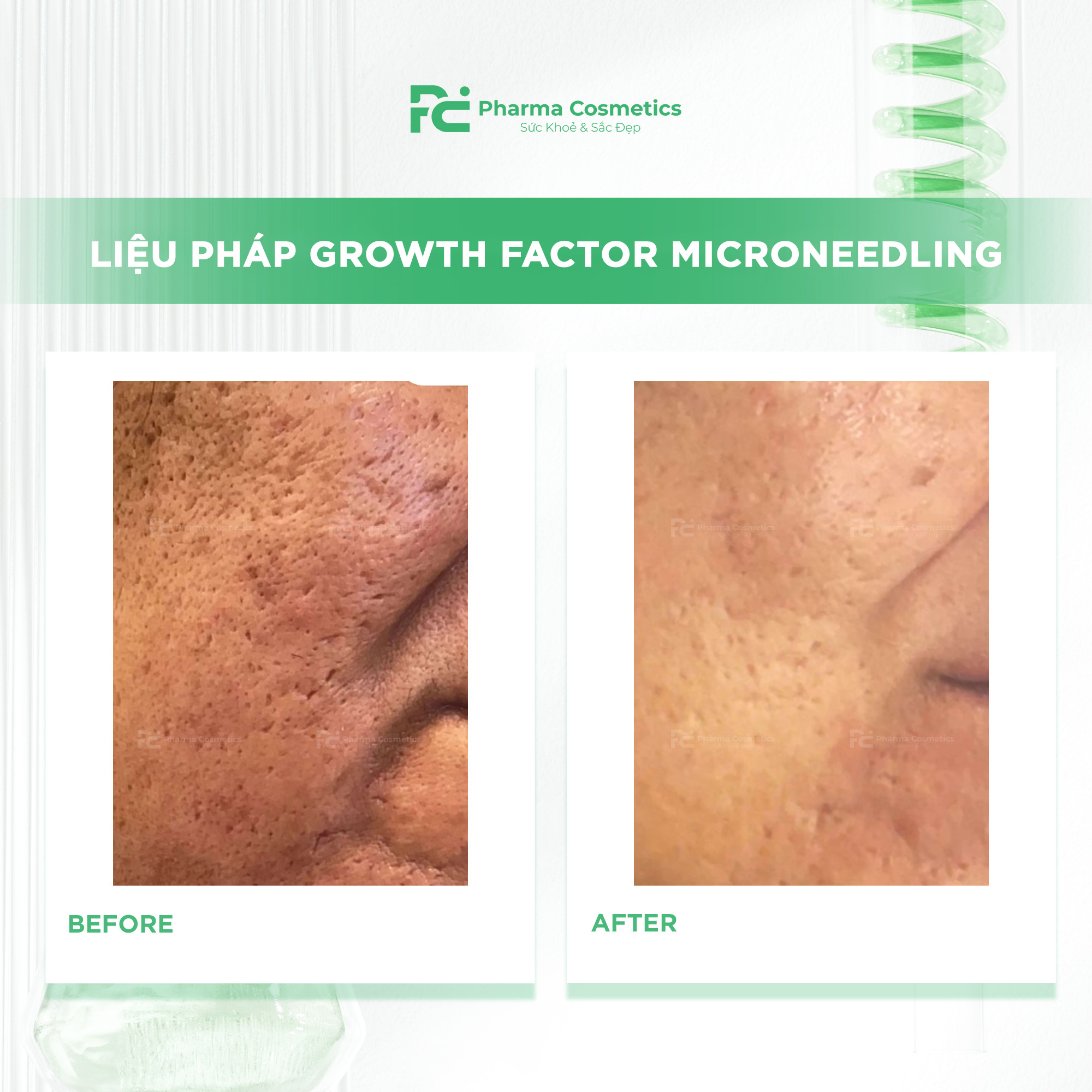 LIỆU PHÁP GROWTH FACTOR MICRONEEDLING: Giải Pháp Toàn Diện Cho Làn Da Sẹo Mụn, Lão Hóa, Thâm Nám