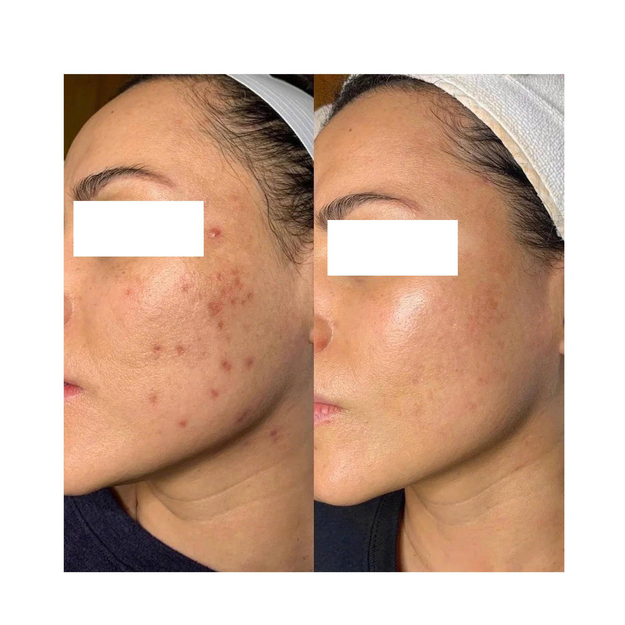 LIỆU PHÁP GROWTH FACTOR MICRONEEDLING: Giải Pháp Toàn Diện Cho Làn Da Sẹo Mụn, Lão Hóa, Thâm Nám