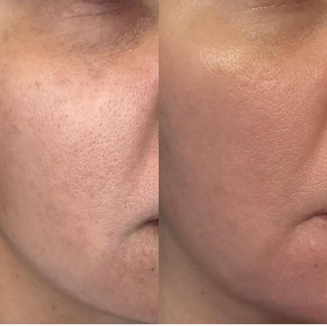 TRỊ LIỆU CHUYÊN SÂU GLOW-UP: Giải Pháp Toàn Diện Cho Làn Da Đô Thị