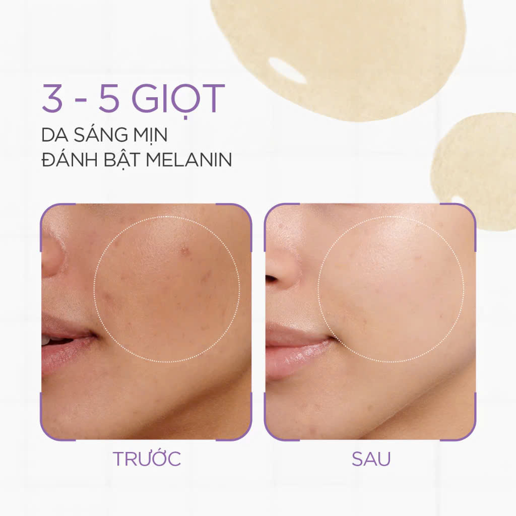 ILUMA® INTENSE FACIAL ILLUMINATOR / SERUM MỜ THÂM NÁM, SÁNG DA, GIẢM MAO MẠCH MÁU