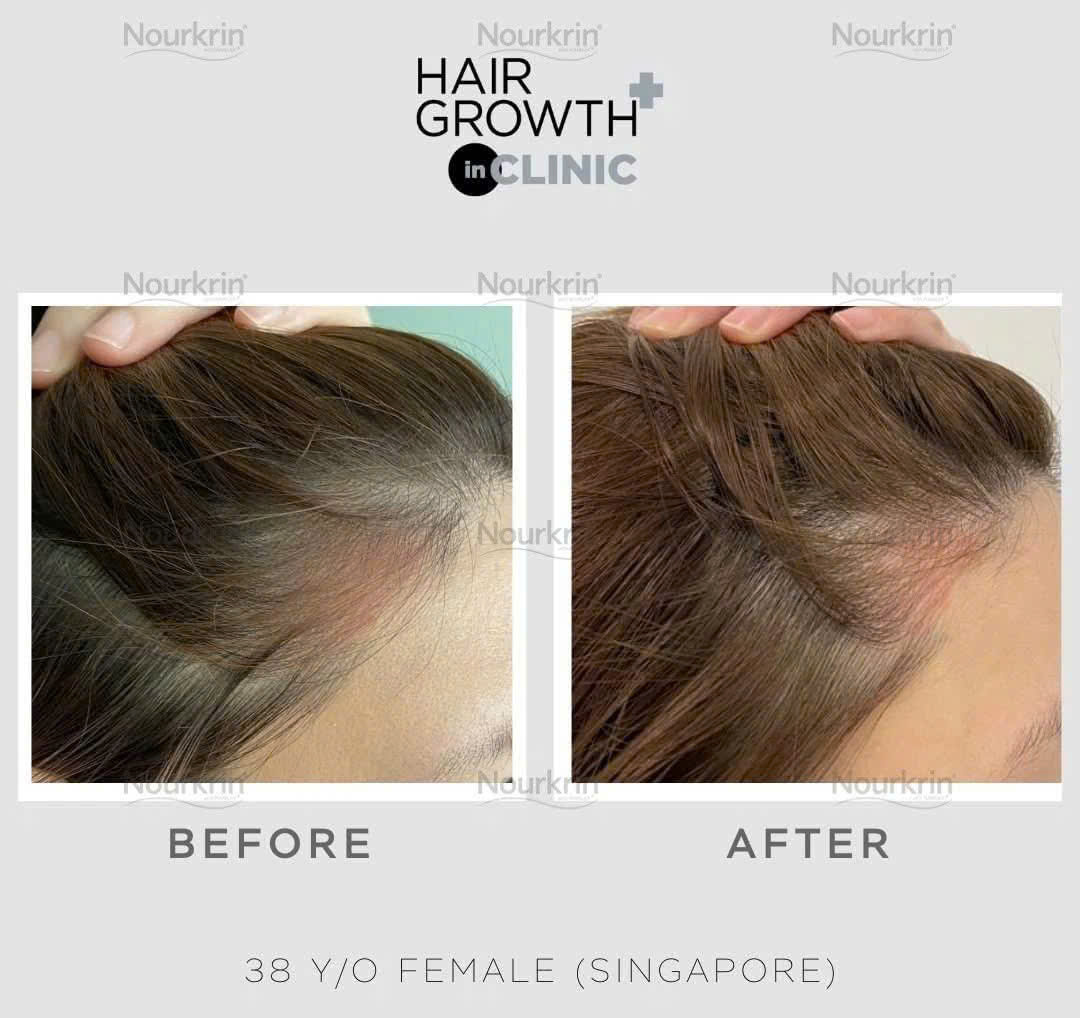 NOURKRIN HAIR GROWTH + IN CLINIC / VIÊN UỐNG MỌC TÓC