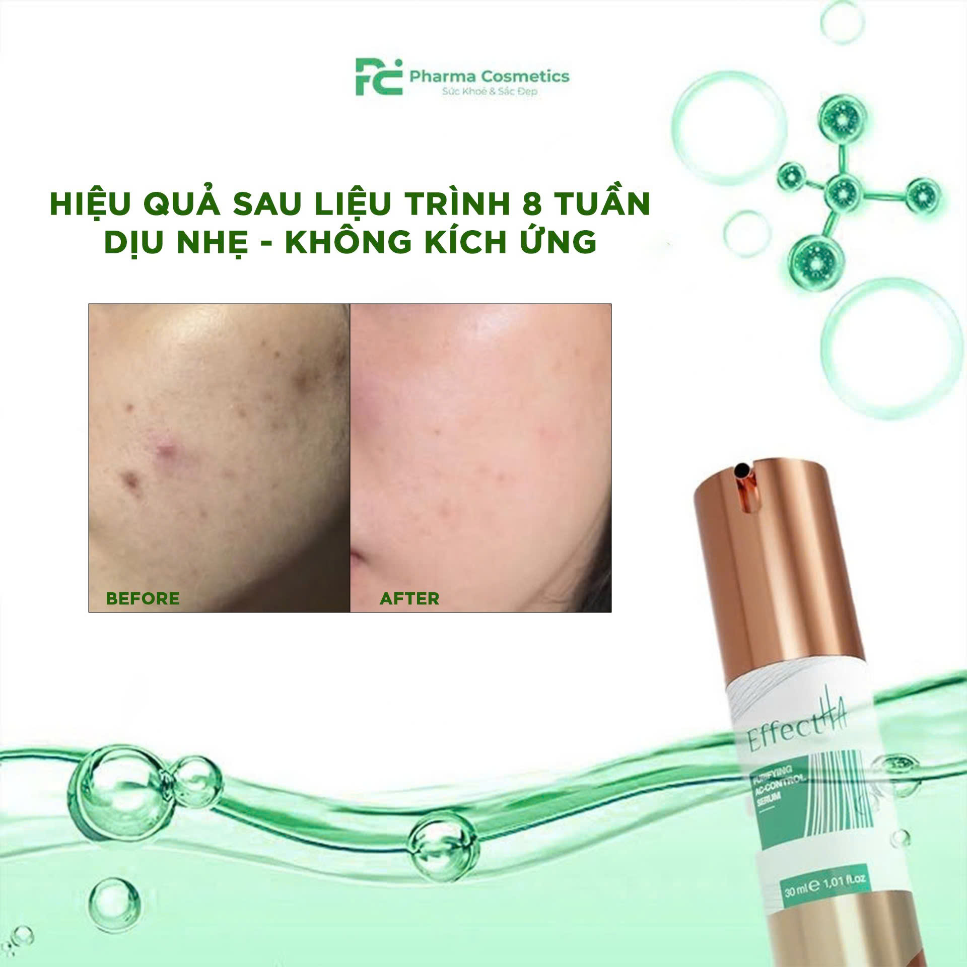 EFFECTHA PURIFYING AC CONTROL SERUM: Huyết Thanh Thanh Lọc & Kiểm Soát Mụn Hiệu Quả Cho Làn Da Sáng Khỏe