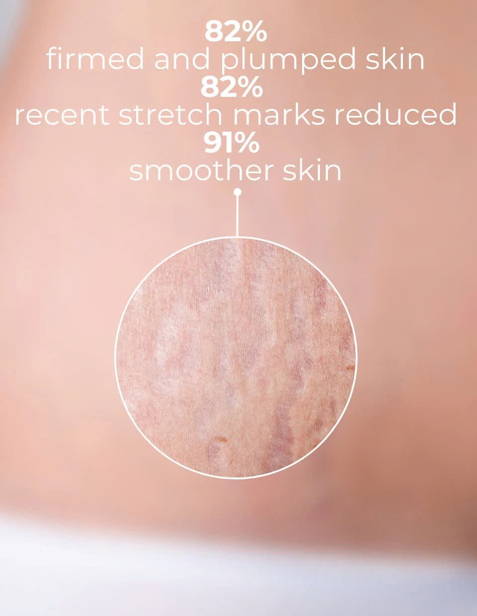 DERMEDEN STRETCH MARK CARE: Kem Ngừa & Cải Thiện Rạn Da, Cho Làn Da Săn Chắc & Mịn Màng