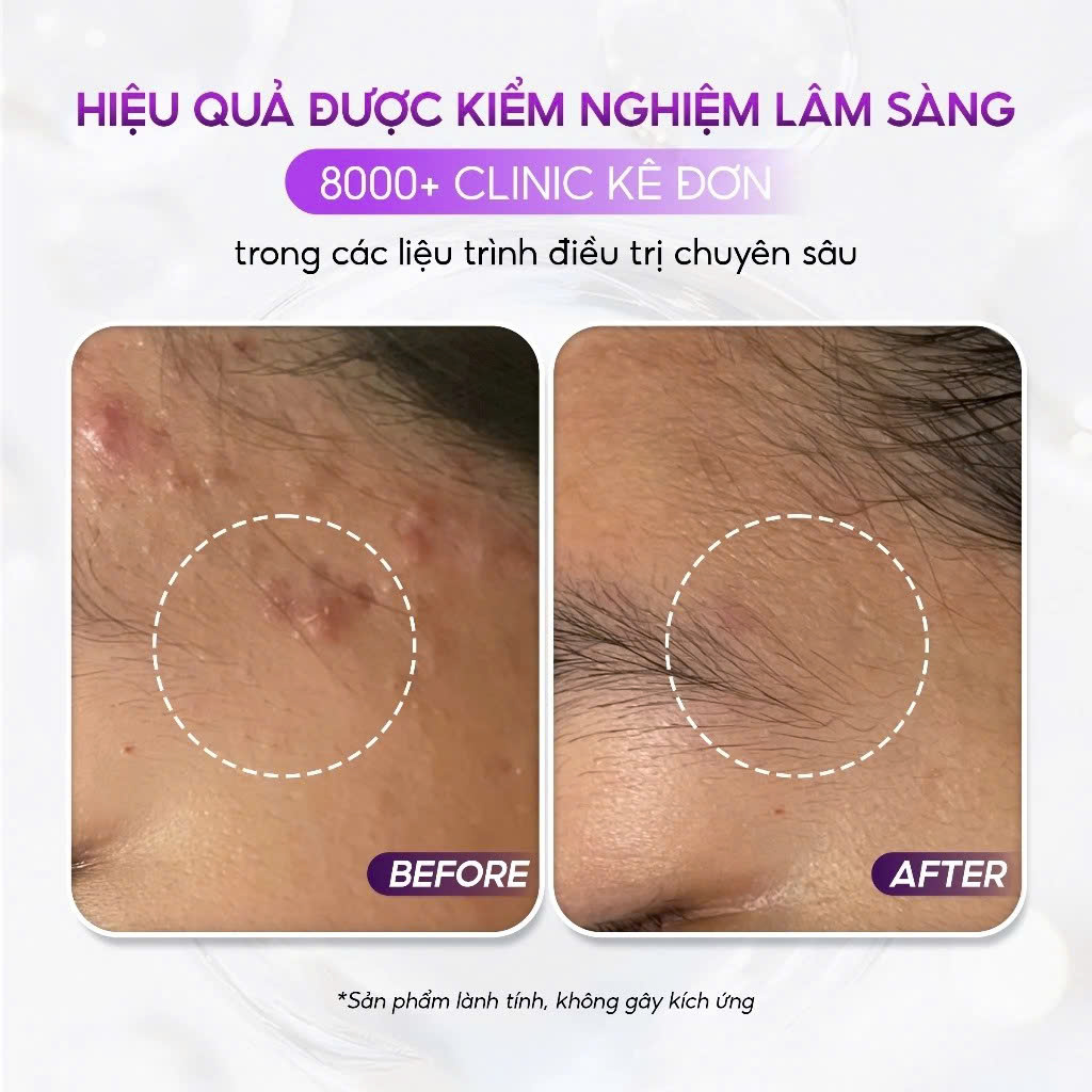 CONAPIDIL FIXICA 13g: Gel Dưỡng & Phục Hồi Da Sau Mụn & Sau Liệu Trình