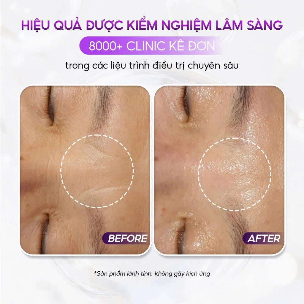 CONAPIDIL CEMENZAL LIGHT: Kem Dưỡng Tái Tạo Da, Hỗ Trợ Nâng Cơ & Cải Thiện Sẹo Rỗ