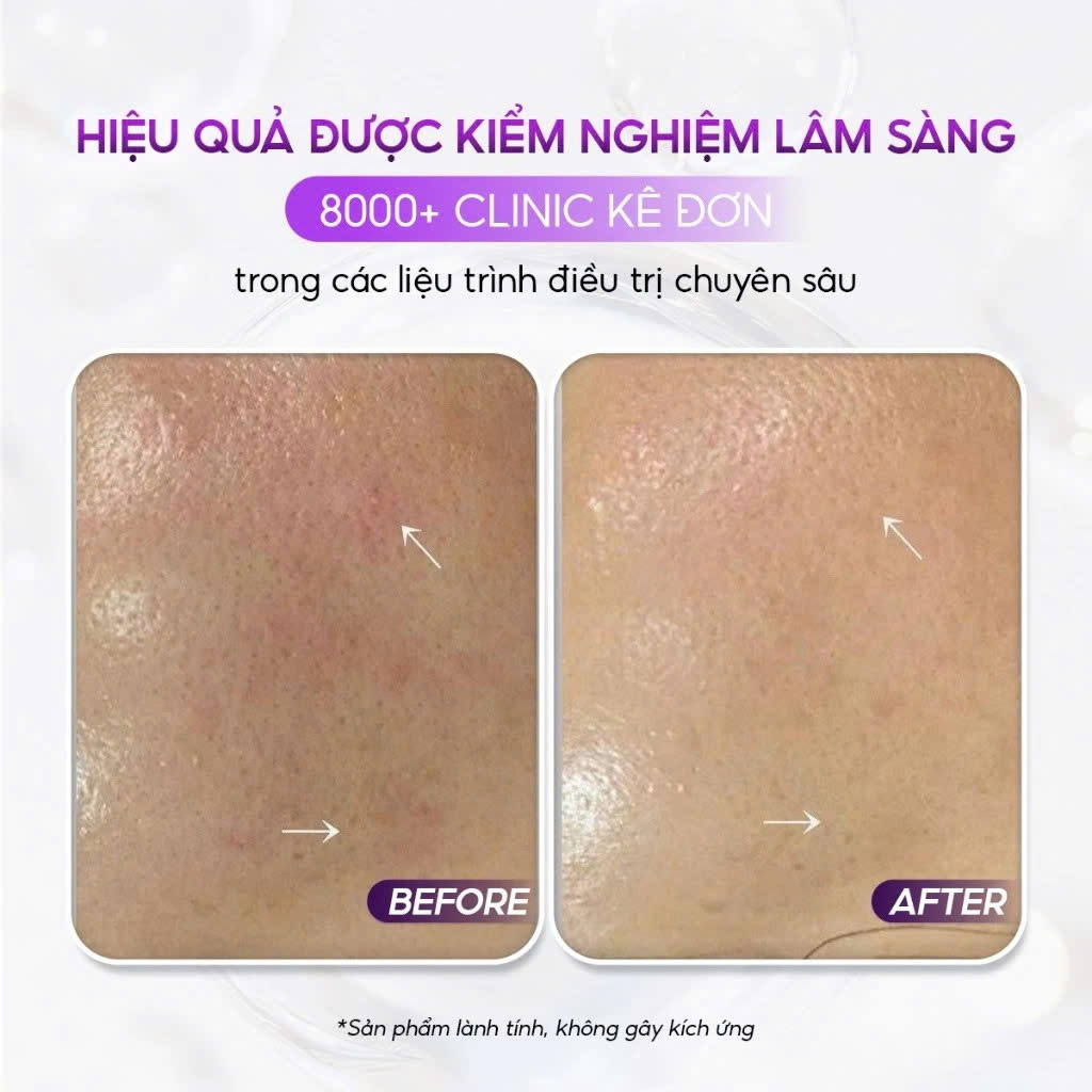CONAPIDIL CEMENZAL LIGHT: Kem Dưỡng Tái Tạo Da, Hỗ Trợ Nâng Cơ & Cải Thiện Sẹo Rỗ