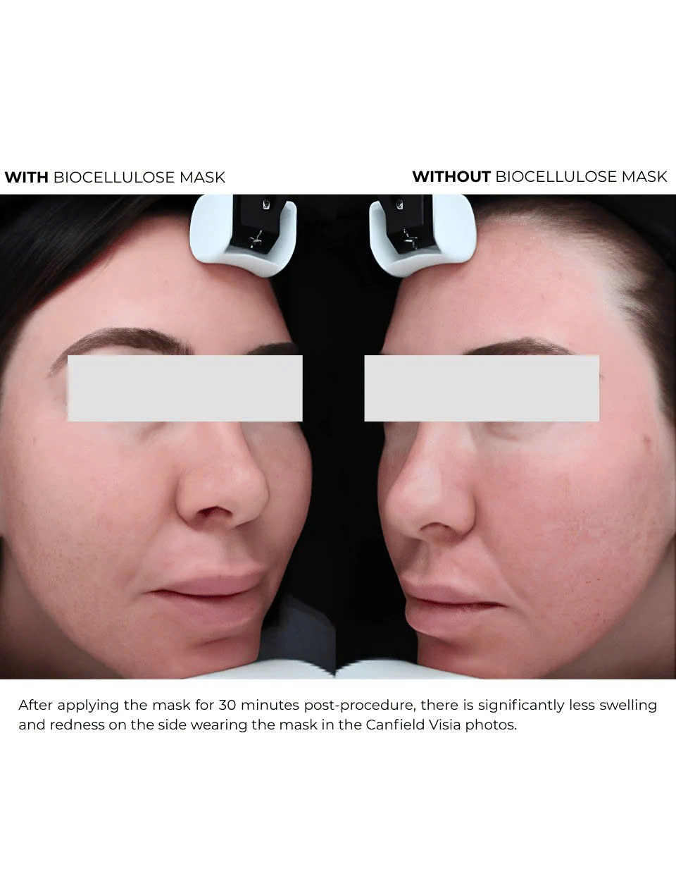 DERMEDEN BIOCELLULOSE: Mặt Nạ Cấp Ẩm & Phục Hồi Chuyên Sâu, Hạn Chế Tăng Sắc Tố Sau Liệu Trình