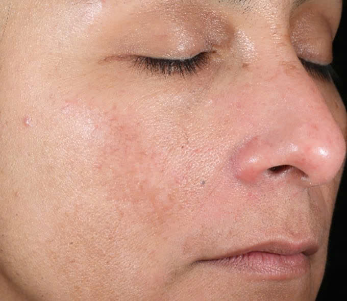 IS CLINICAL ACTIVE PEEL SYSTEM: Bộ Đôi Tái Tạo Da Chuyên Sâu, Cho Làn Da Căng Bóng & Mịn Màng
