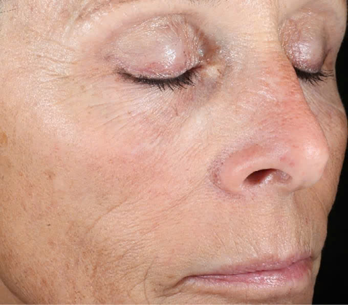 IS CLINICAL ACTIVE PEEL SYSTEM: Bộ Đôi Tái Tạo Da Chuyên Sâu, Cho Làn Da Căng Bóng & Mịn Màng