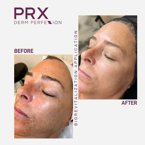 WiQo PRX-PLUS: Giải Pháp Trẻ Hoá Toàn Diện, Không Xâm Lấn